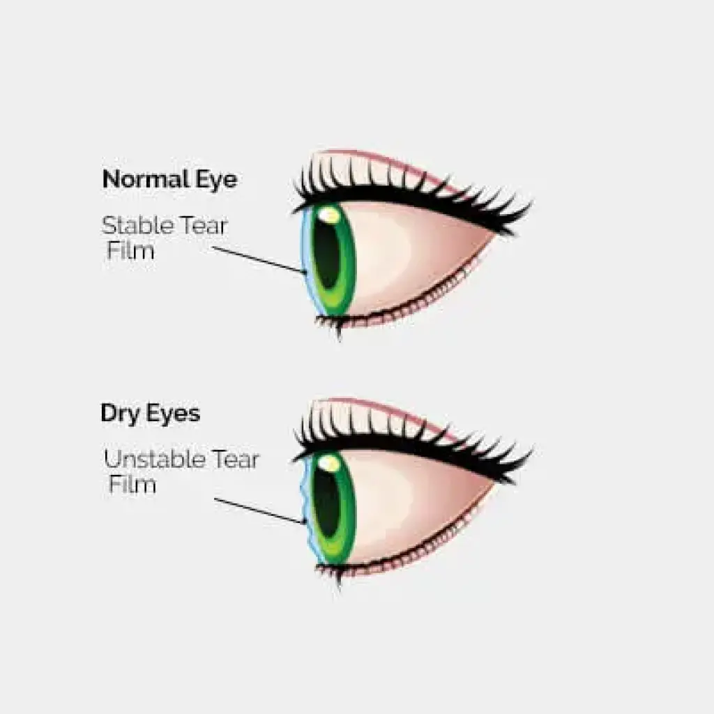 Growing number of dry eye patients will benefit from ongoing treatment innovation